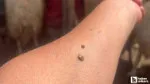 Kene ısırdığında sakın bunları yapmayın!